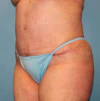 Tummy Tuck