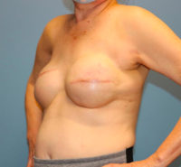 Skin Sparing Reconstruction