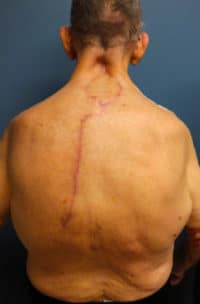 Complex Back and Spine Reconstruction