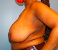 Breast Reduction