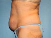Tummy Tuck