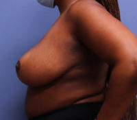 Breast Reduction