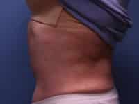 Tummy Tuck