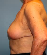 Oncoplastic Breast Reconstruction