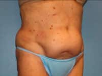 Tummy Tuck