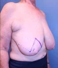 Oncoplastic Breast Reconstruction