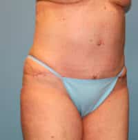 Tummy Tuck