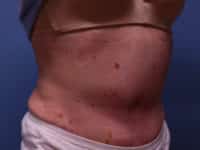 Tummy Tuck