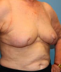 Oncoplastic Breast Reconstruction