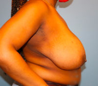 Breast Reduction
