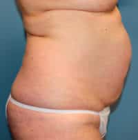 Tummy Tuck