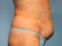 Tummy Tuck
