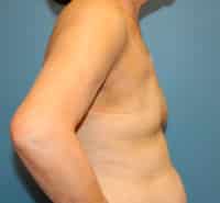 Skin Sparing Reconstruction