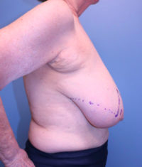 Oncoplastic Breast Reconstruction