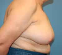 Oncoplastic Breast Reconstruction