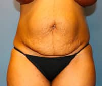 Tummy Tuck