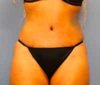 Tummy Tuck