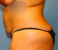 Tummy Tuck