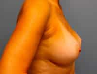 Breast Augmentation