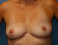 Breast Augmentation