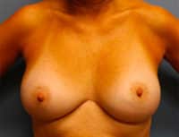 Breast Augmentation