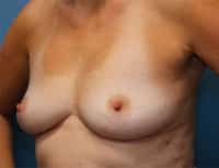 Breast Augmentation