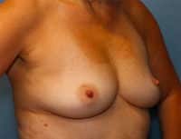 Breast Augmentation