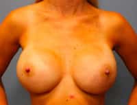 Nipple Sparing Reconstruction