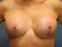 Breast Lift with Augmentation