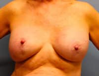 Breast Lift with Augmentation