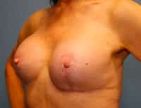 Breast Lift with Augmentation