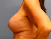 Breast Lift with Augmentation