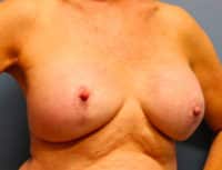 Breast Lift with Augmentation