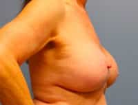 Breast Lift with Augmentation