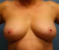 Skin Sparing Reconstruction