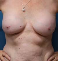 Breast Implant Removal