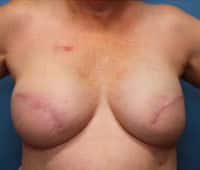 Skin Sparing Reconstruction