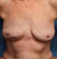 Breast Implant Removal