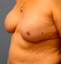 Breast Implant Removal