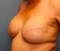 Skin Sparing Reconstruction