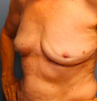 Breast Implant Removal