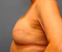 Skin Sparing Reconstruction