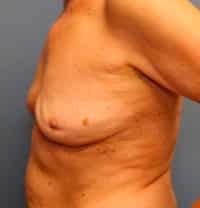 Breast Implant Removal