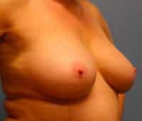 Skin Sparing Reconstruction