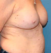 Breast Implant Removal