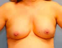 Breast Augmentation