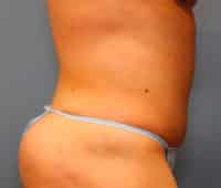 Tummy Tuck