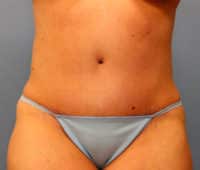 Tummy Tuck