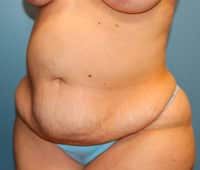 Tummy Tuck