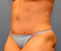 Tummy Tuck